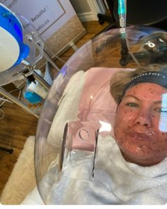 Hydrabrasion facial and hydrabrasion therapy london ontario