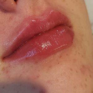 Lip filler treatment in london ontario